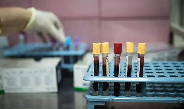 Kanserle mücadelesi Dünya Kanser Gününde zaferle sonuçlandı Kanserle mücadelesi Dünya Kanser Gününde zaferle sonuçlandı